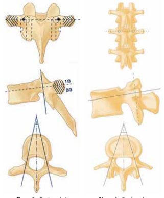 technique du cintrage in situ dans les fractures thoraco-lombaire